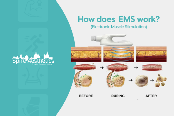 EMS treatment for post pregnancy weight loss treatment Ashtead