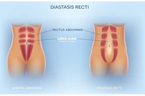 What Non-Surgical Options Are Available for Diastasis Recti Ashtead?