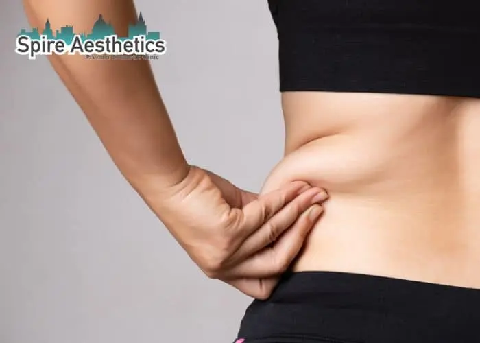 Image of woman pinching fat on their hips Ashtead. Fat Freezing treatment