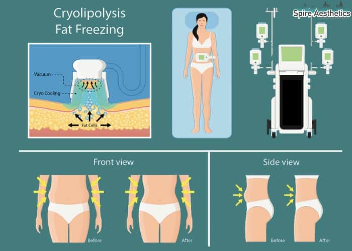 Image of diet and fat freezing combined for best results for Spire Aesthetics Ashtead