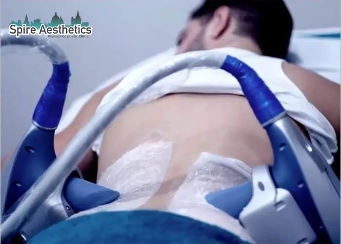 Man having fat freezing treatment done on love handles before a competitions Ashtead to create a sculpted look.