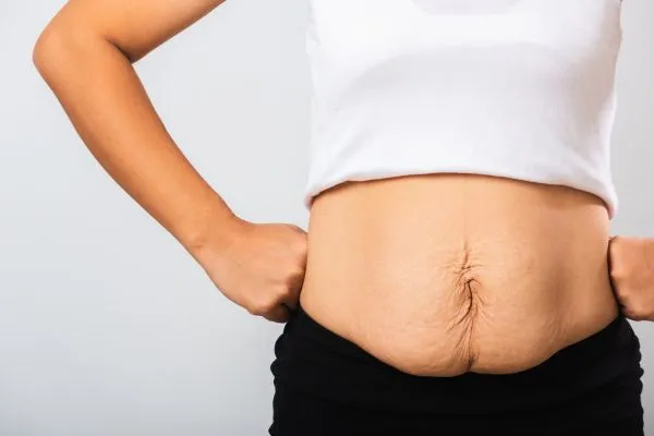 Image of a woman's stomach after weight loss with sagging skin following a gastric band Ashtead