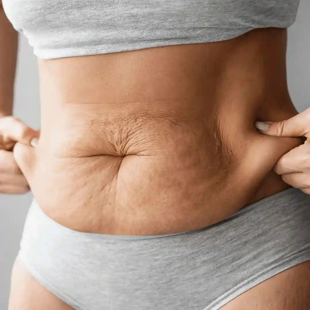 Is It Normal to Have Loose Skin After Pregnancy Ashtead?