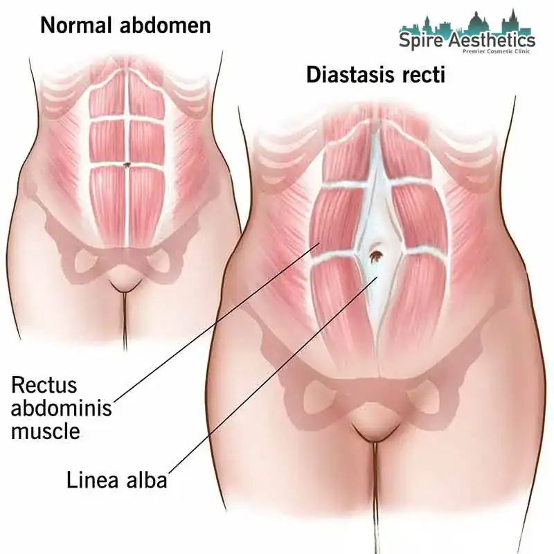 When Will My Belly Feel Normal Again Ashtead?