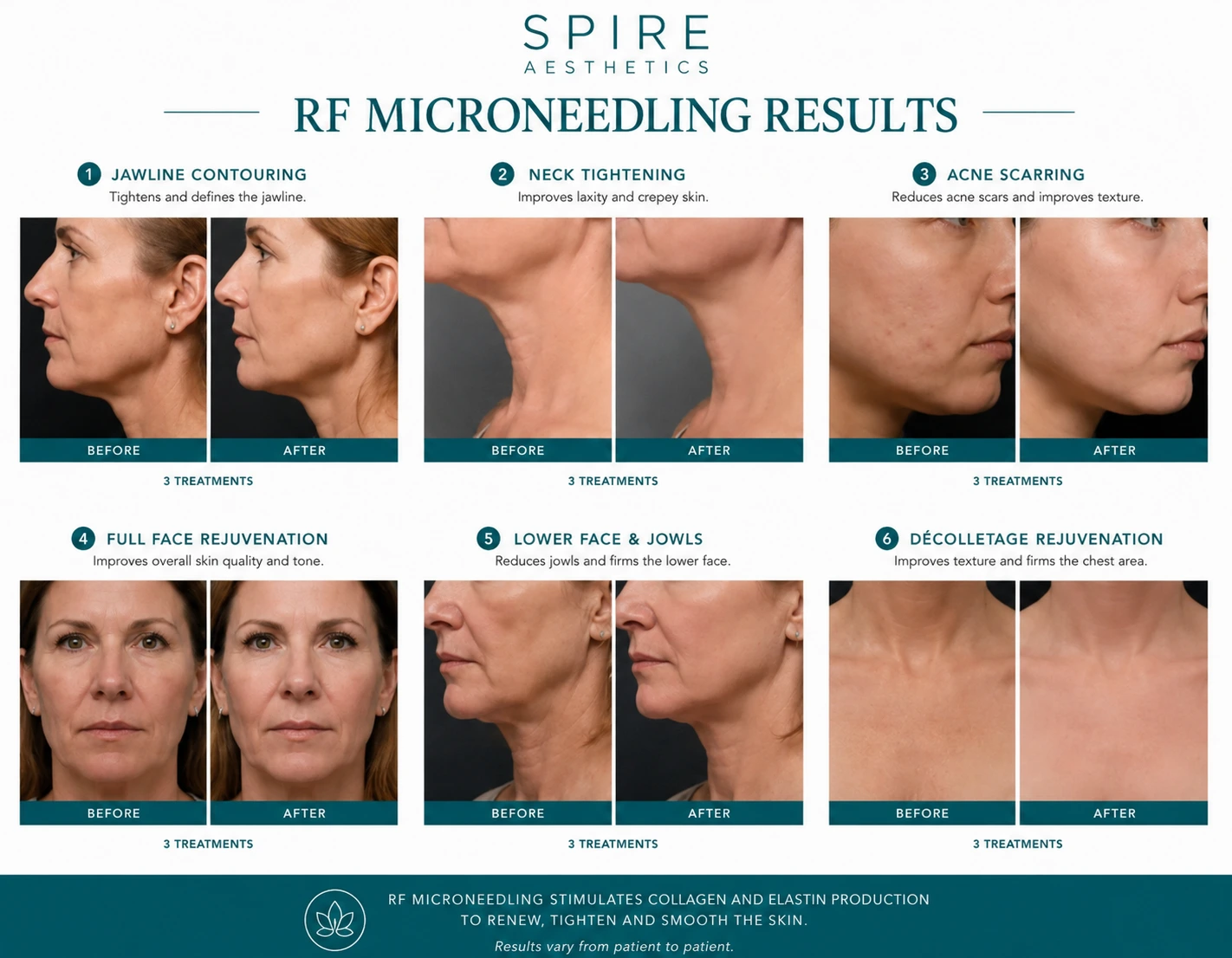 RF Microneedling Skin tightening Ashtead results