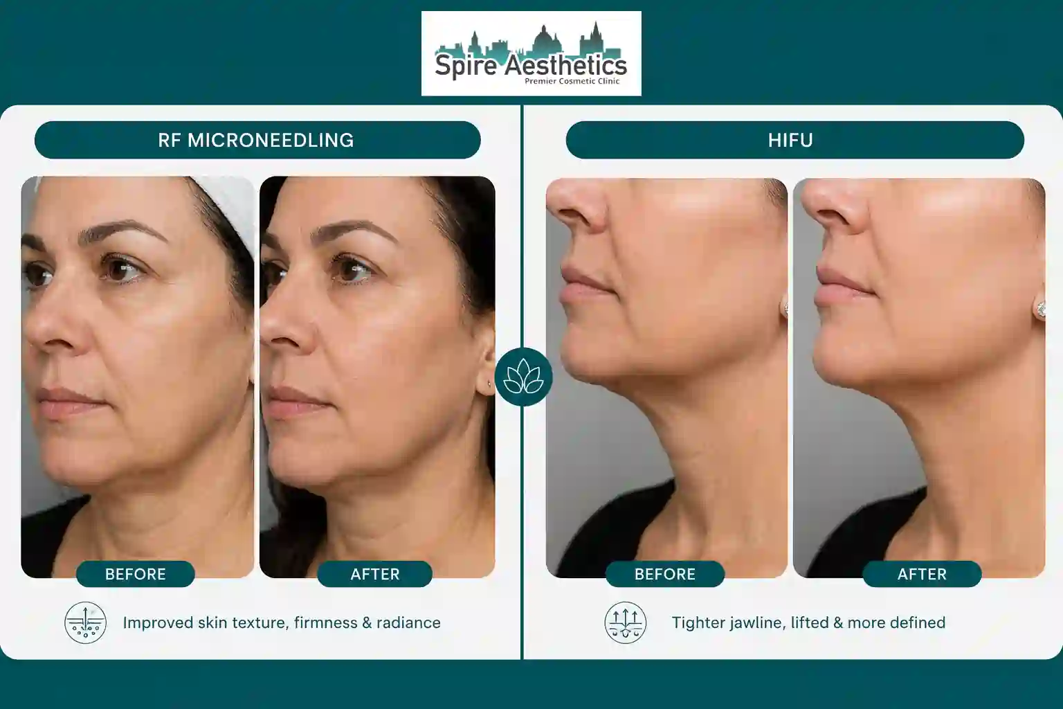 Can RF Microneedling and HIFU Be Combined Ashtead?