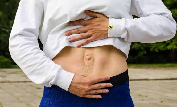 When Could Diastasis Recti Be the Missing Piece of the Puzzle Ashtead?