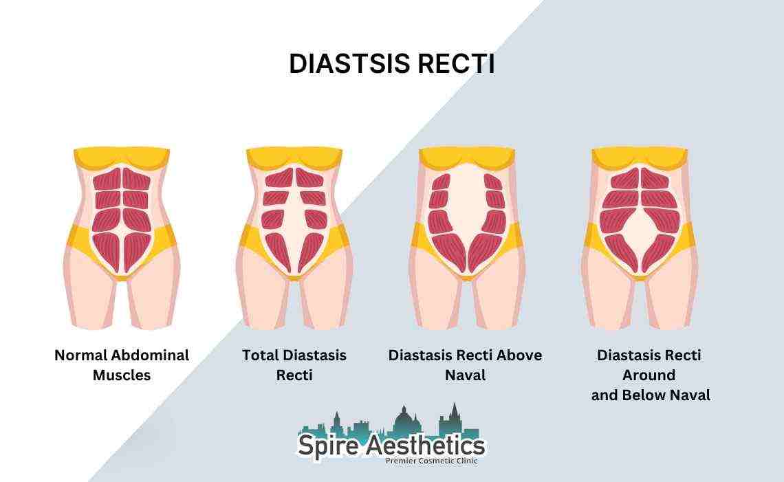 Is Non-Surgical Diastasis Recti Treatment Right for You? Common Concerns Answered Ashtead